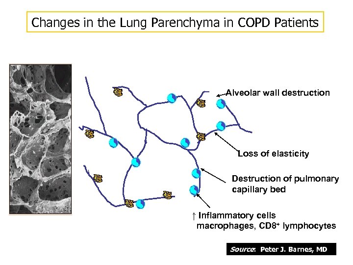 Changes in the Lung Parenchyma in COPD Patients Alveolar wall destruction Loss of elasticity