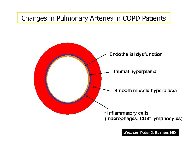 Changes in Pulmonary Arteries in COPD Patients Endothelial dysfunction Intimal hyperplasia Smooth muscle hyperplasia