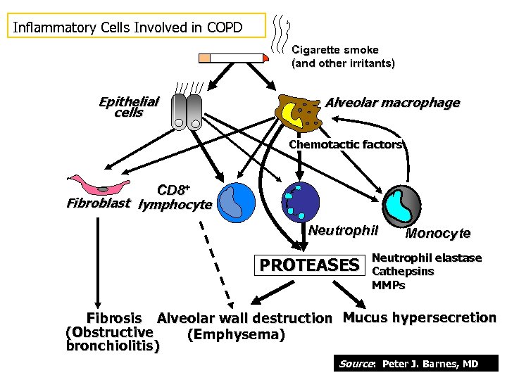 Inflammatory Cells Involved in COPD Cigarette smoke (and other irritants) Epithelial cells Alveolar macrophage