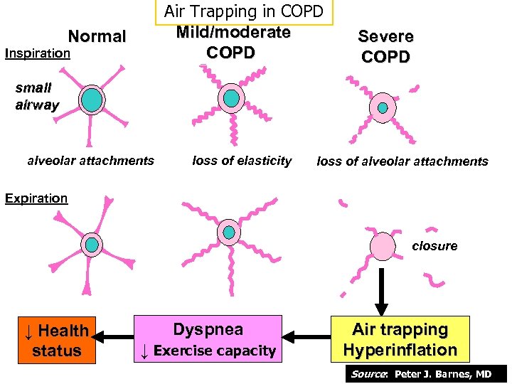 Air Trapping in COPD Mild/moderate COPD Normal Inspiration Severe COPD small airway alveolar attachments