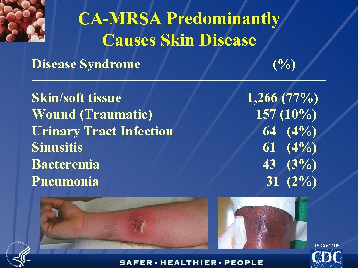 CA-MRSA Predominantly Causes Skin Disease Syndrome Skin/soft tissue Wound (Traumatic) Urinary Tract Infection Sinusitis