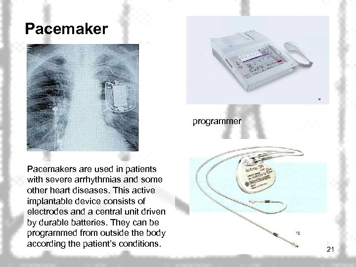 Pacemaker programmer Pacemakers are used in patients with severe arrhythmias and some other heart