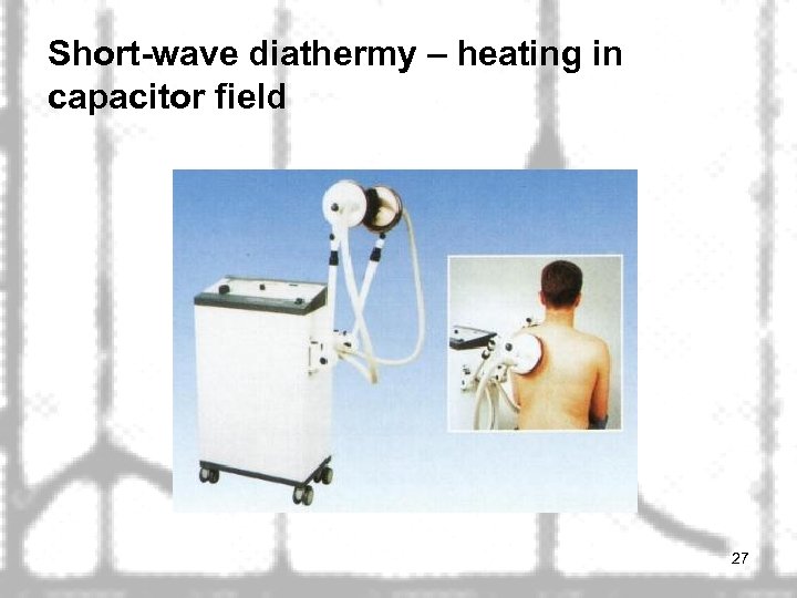 Short-wave diathermy – heating in capacitor field 27 