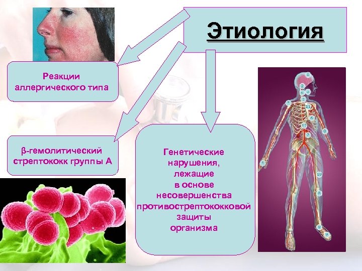 Этиология Реакции аллергического типа β-гемолитический стрептококк группы А Генетические нарушения, лежащие в основе несовершенства