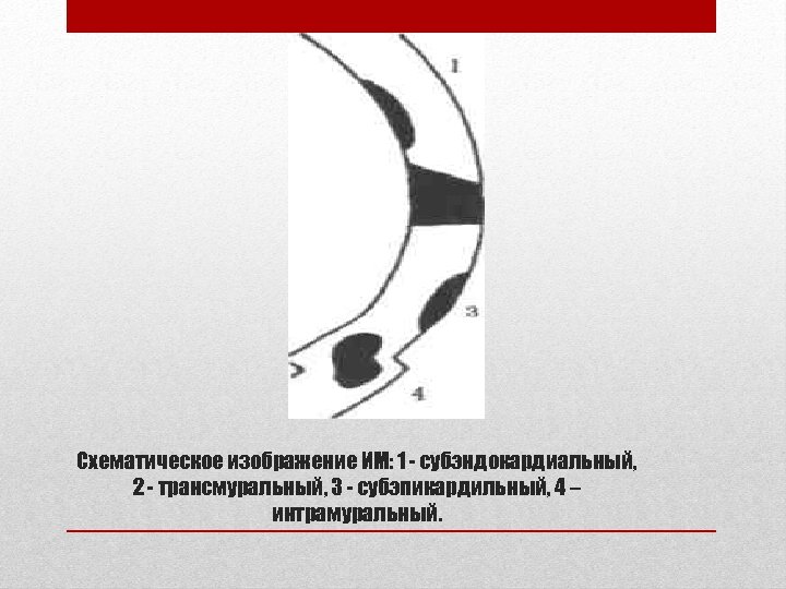 Схематическое изображение ИМ: 1 - субэндокардиальный, 2 - трансмуральный, 3 - субэпикардильный, 4 –