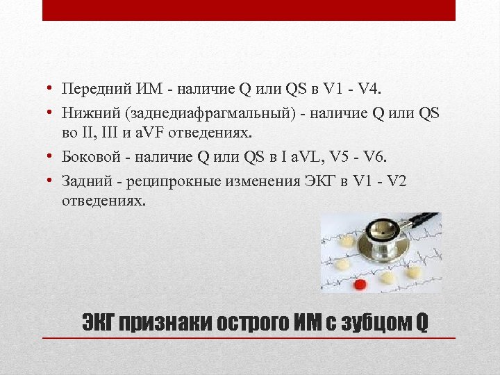  • Передний ИМ - наличие Q или QS в V 1 - V