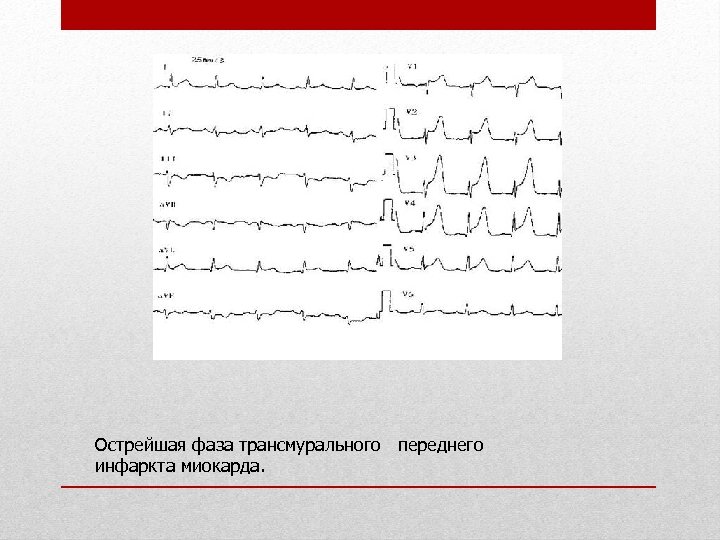 Острейшая фаза трансмурального переднего инфаркта миокарда. 