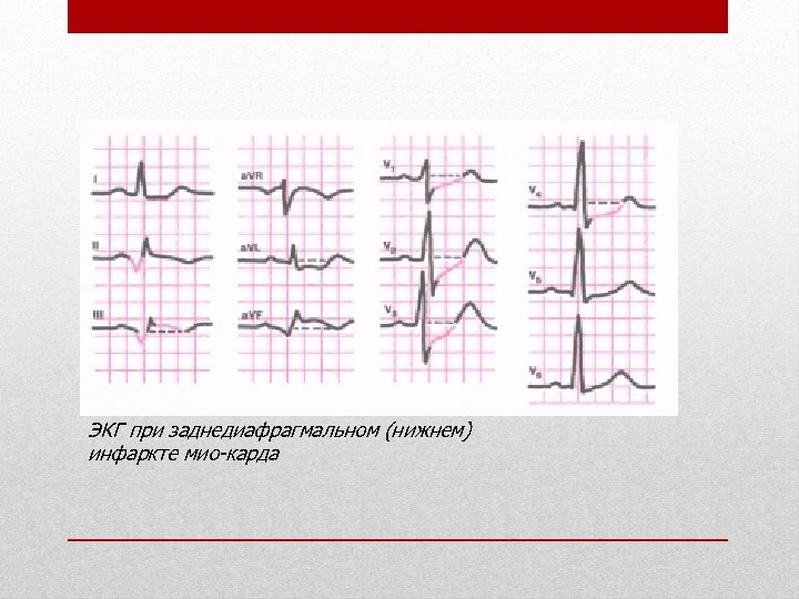 ЭКГ при заднедиафрагмальном (нижнем) инфаркте мио карда 