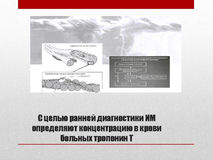 С целью ранней диагностики ИМ определяют концентрацию в крови больных тропонин Т 