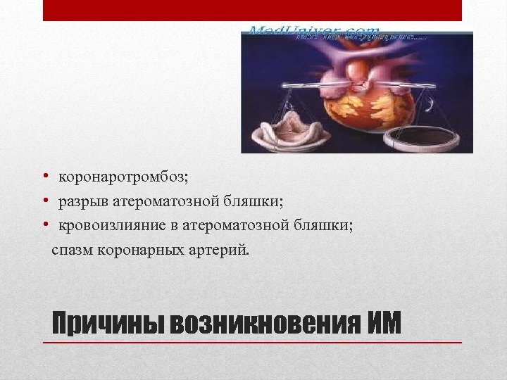  • коронаротромбоз; • разрыв атероматозной бляшки; • кровоизлияние в атероматозной бляшки; спазм коронарных