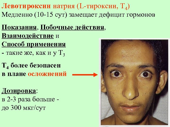 Левотироксин натрия (L-тироксин, Т 4) Медленно (10 -15 сут) замещает дефицит гормонов Показания, Побочные