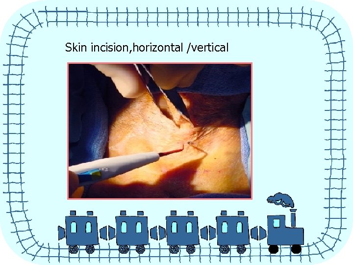 Skin incision, horizontal /vertical 