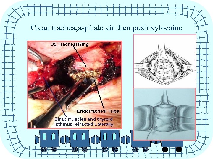 Clean trachea, aspirate air then push xylocaine 