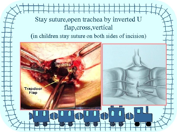 Stay suture, open trachea by inverted U flap, cross, vertical (in children stay suture