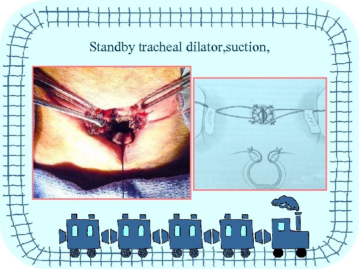 Standby tracheal dilator, suction, 