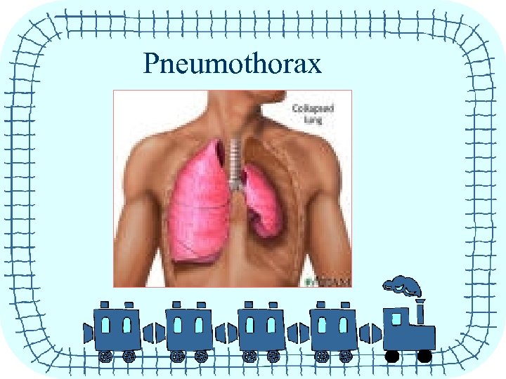 Pneumothorax 