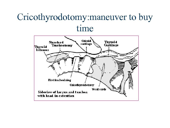 Cricothyrodotomy: maneuver to buy time 