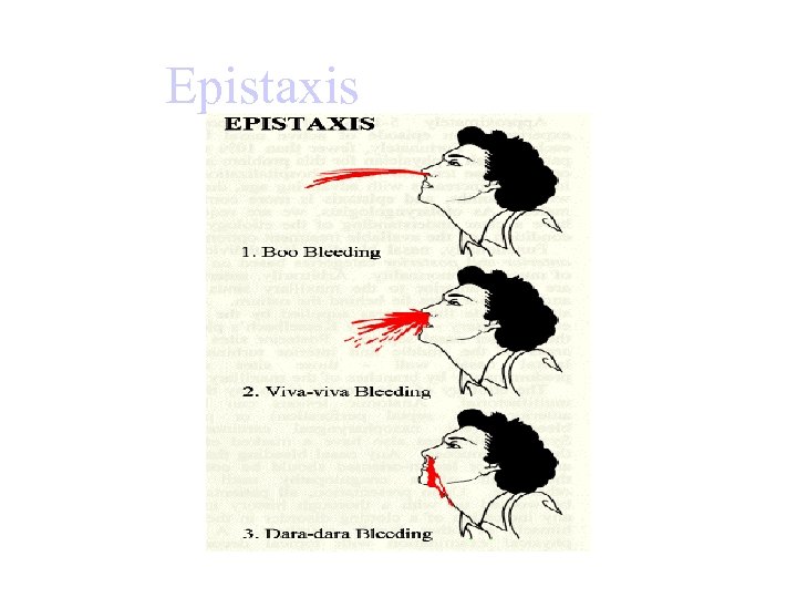 Epistaxis 