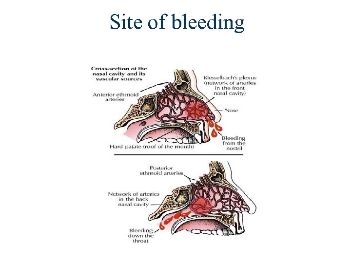 Site of bleeding 