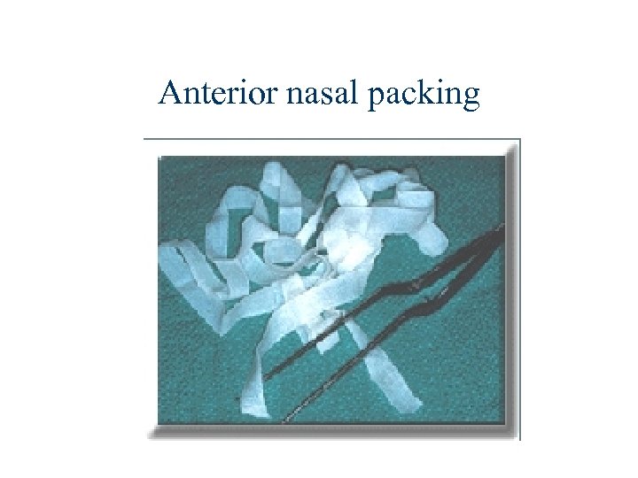 Anterior nasal packing 