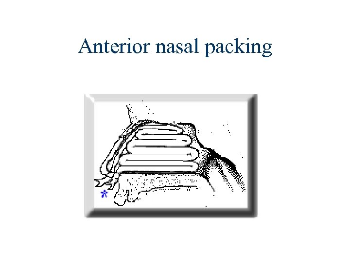 Anterior nasal packing 