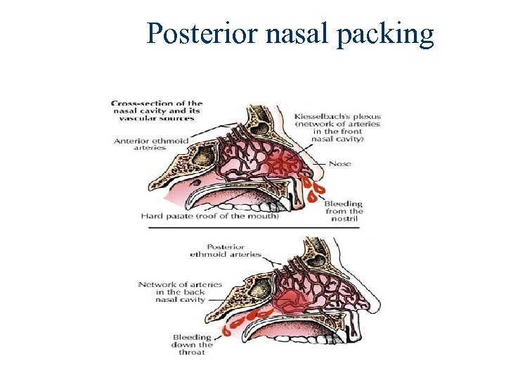 Posterior nasal packing 