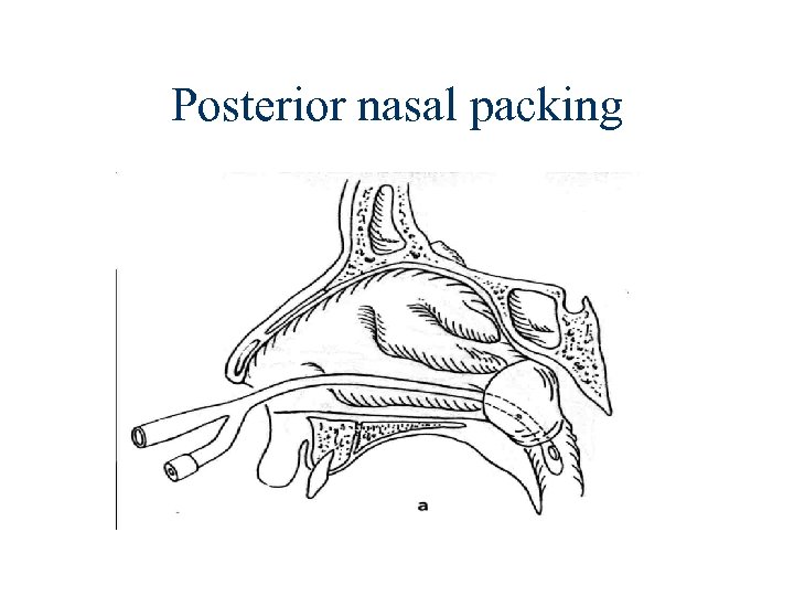 Posterior nasal packing 