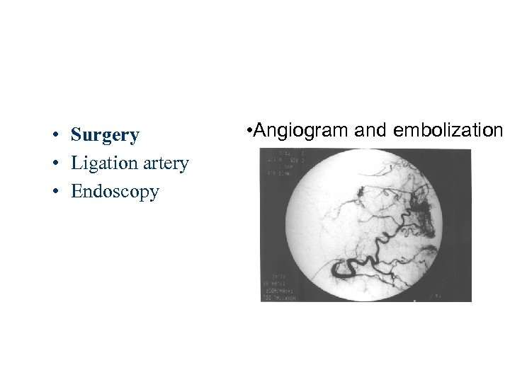  • Surgery • Ligation artery • Endoscopy • Angiogram and embolization 