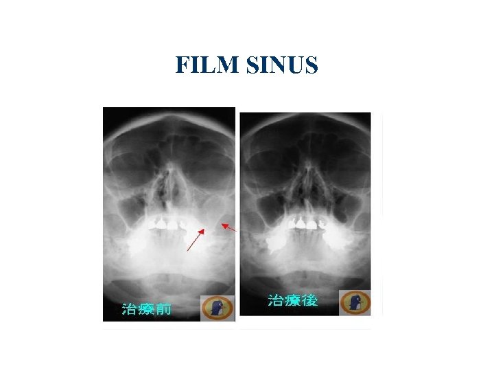 FILM SINUS 