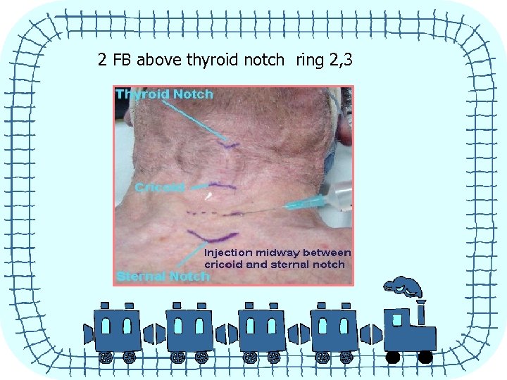 2 FB above thyroid notch ring 2, 3 