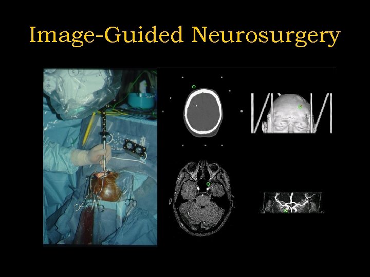 Image-Guided Neurosurgery 