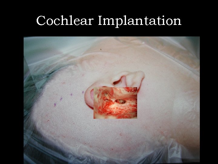 Cochlear Implantation 
