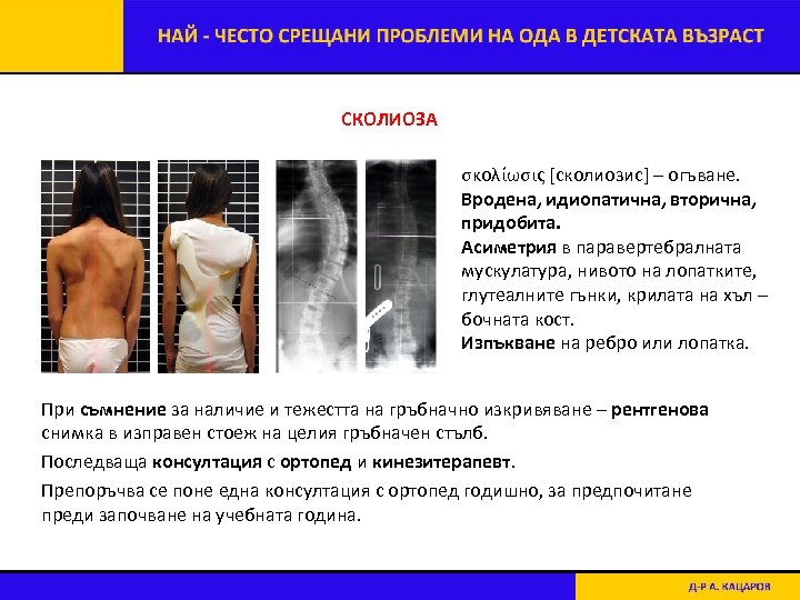 СКОЛИОЗА σκολίωσις [сколиозис] – огъване. Вродена, идиопатична, вторична, придобита. Асиметрия в паравертебралната мускулатура, нивото