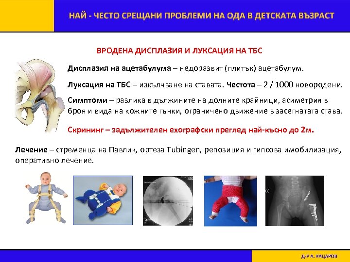 ВРОДЕНА ДИСПЛАЗИЯ И ЛУКСАЦИЯ НА ТБС Дисплазия на ацетабулума – недоразвит (плитък) ацетабулум. Луксация
