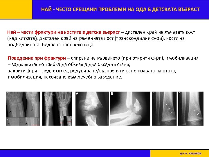 Най – чести фрактури на костите в детска възраст – дистален край на лъчевата