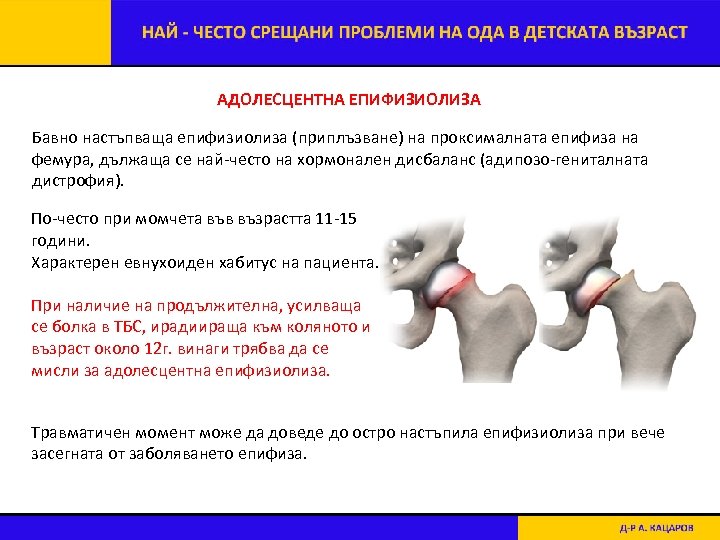АДОЛЕСЦЕНТНА ЕПИФИЗИОЛИЗА Бавно настъпваща епифизиолиза (приплъзване) на проксималната епифиза на фемура, дължаща се най-често