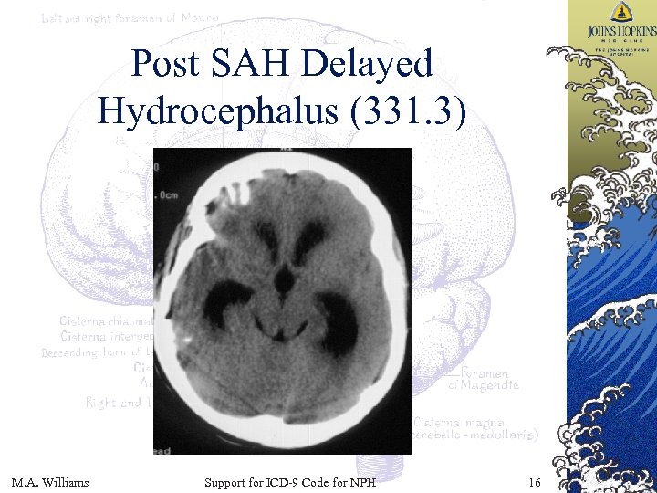 Post SAH Delayed Hydrocephalus (331. 3) M. A. Williams Support for ICD-9 Code for