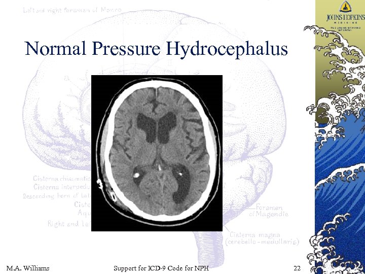 Normal Pressure Hydrocephalus M. A. Williams Support for ICD-9 Code for NPH 22 