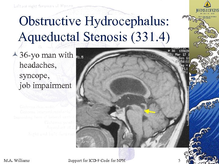 Obstructive Hydrocephalus: Aqueductal Stenosis (331. 4) © 36 -yo man with headaches, syncope, job