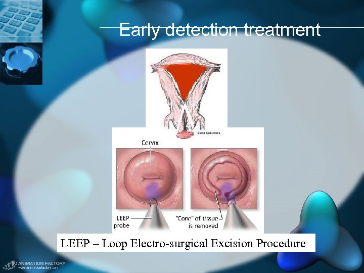 Early detection treatment LEEP – Loop Electro-surgical Excision Procedure 