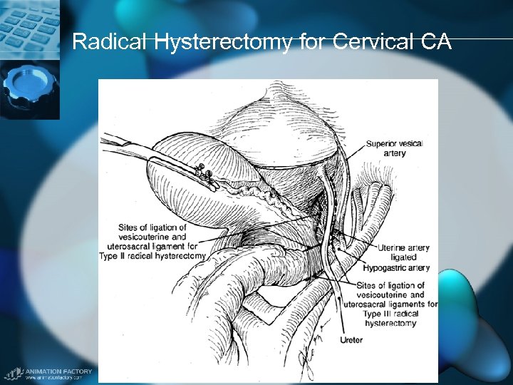 Radical Hysterectomy for Cervical CA 