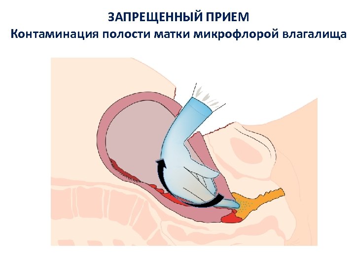 ЗАПРЕЩЕННЫЙ ПРИЕМ Контаминация полости матки микрофлорой влагалища 
