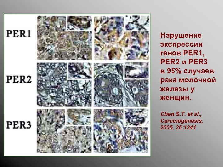 Нарушение экспрессии генов PER 1, PER 2 и PER 3 в 95% случаев рака