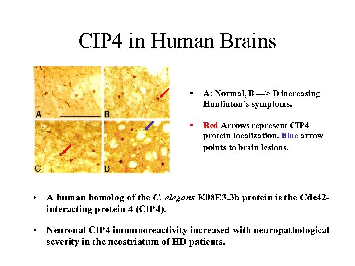 CIP 4 in Human Brains • A: Normal, B ---> D increasing Huntinton’s symptoms.