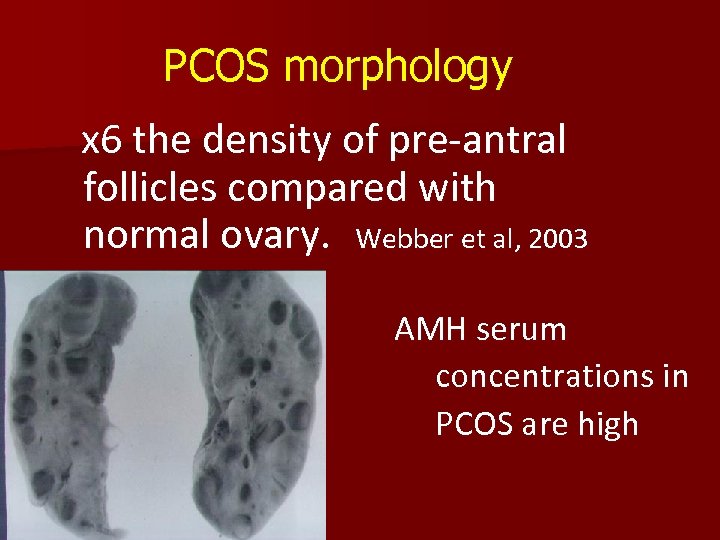 PCOS morphology x 6 the density of pre-antral follicles compared with normal ovary. Webber