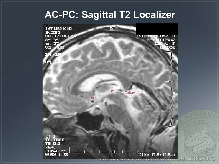 AC-PC: Sagittal T 2 Localizer PC AC Colliculi 