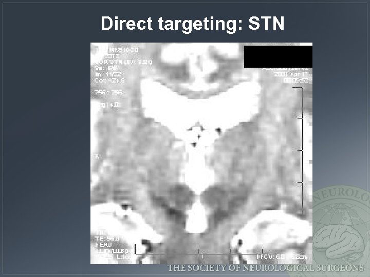 Direct targeting: STN 