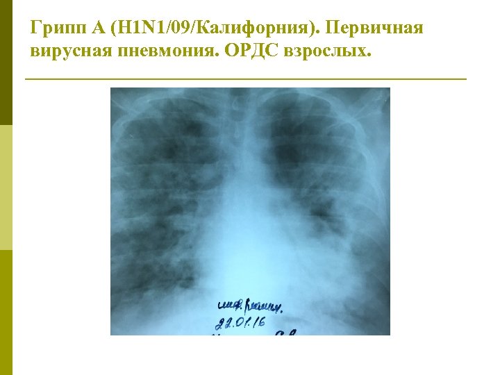 Грипп А (H 1 N 1/09/Калифорния). Первичная вирусная пневмония. ОРДС взрослых. 