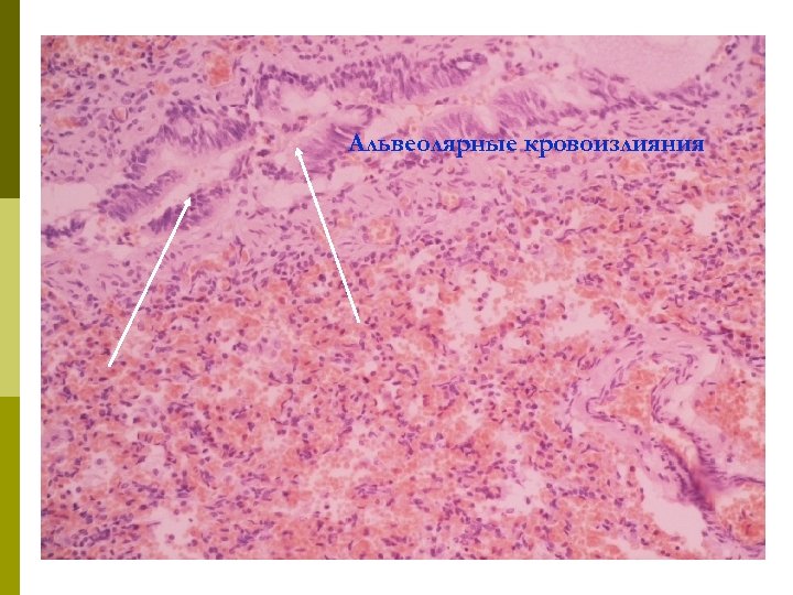 Альвеолярные кровоизлияния 