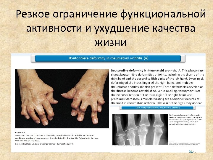 Резкое ограничение функциональной активности и ухудшение качества жизни 